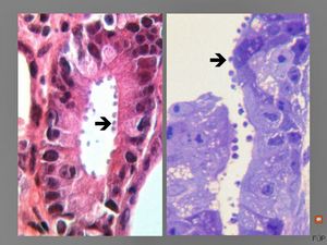 M,33y. | cryptosporidiosis - duodenum, im | munodeficient pacient, HE and toluidine blue staining